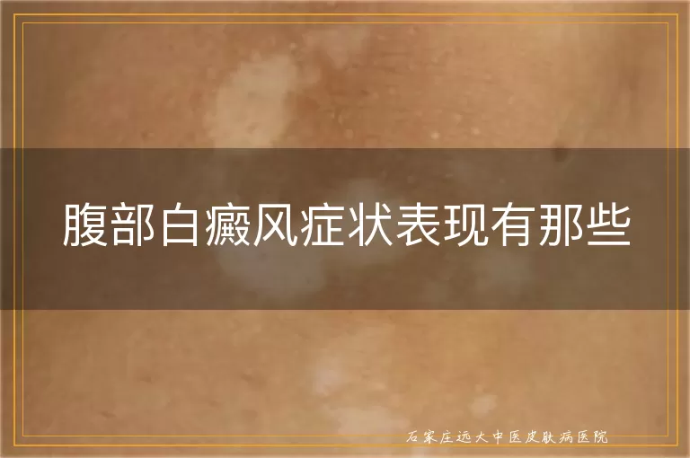 腹部白癜风症状表现有那些