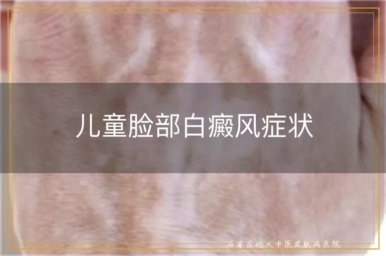 儿童脸部白癜风症状