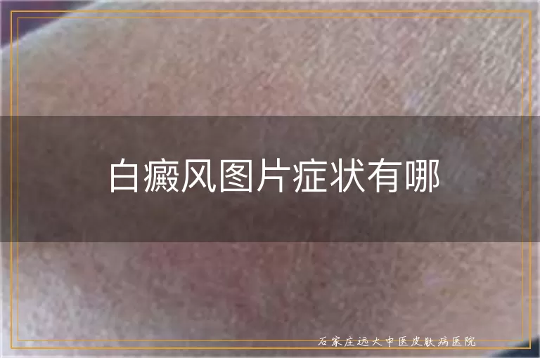 白癜风图片症状有哪