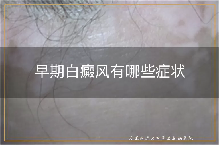 早期白癜风有哪些症状