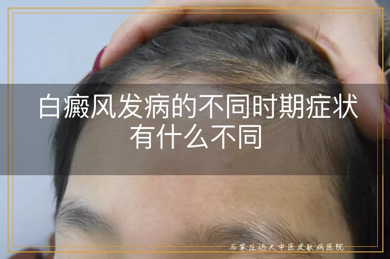白癜风发病的不同时期症状有什么不同
