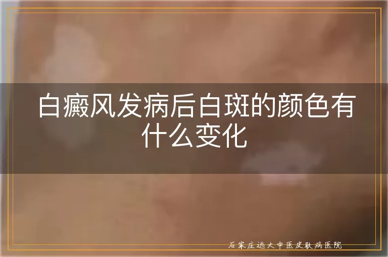 白癜风发病后白斑的颜色有什么变化