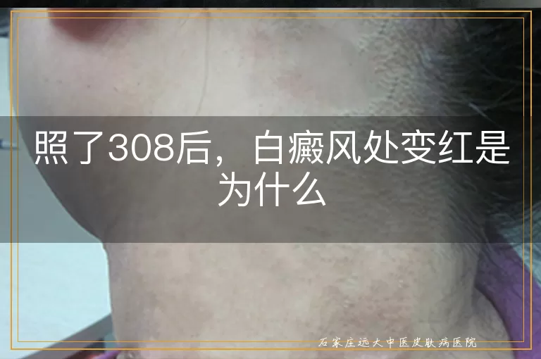 照了308后，白癜风处变红是为什么