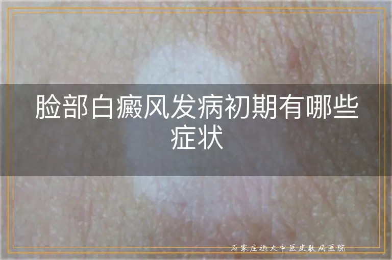 脸部白癜风发病初期有哪些症状