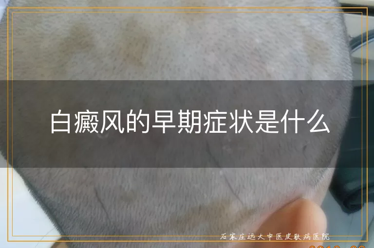 白癜风的早期症状是什么