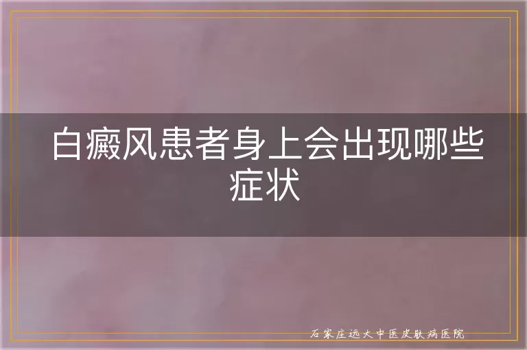 白癜风患者身上会出现哪些症状