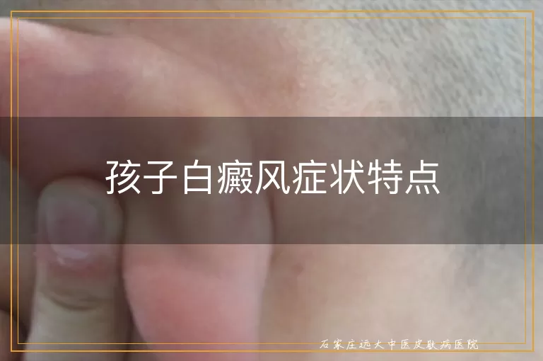 孩子白癜风症状特点