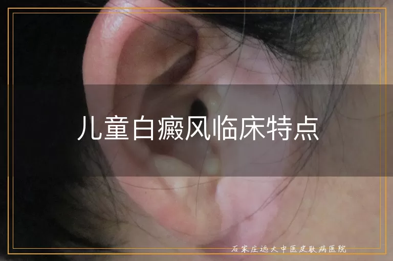 儿童白癜风临床特点