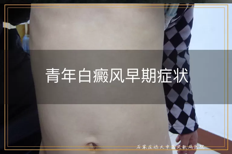 青年白癜风早期症状