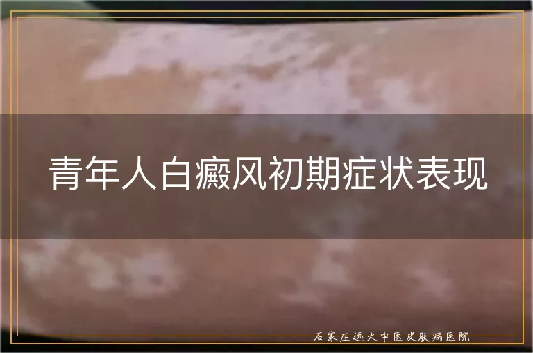 青年人白癜风初期症状表现