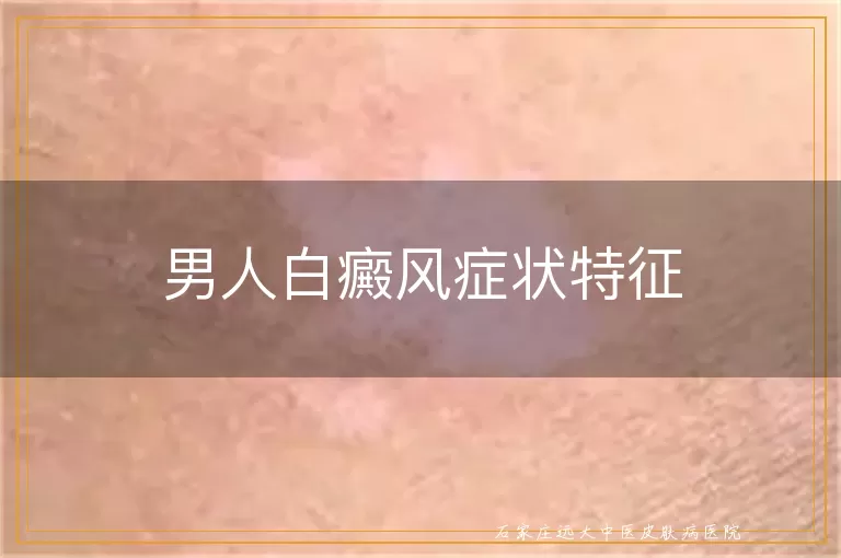 男人白癜风症状特征