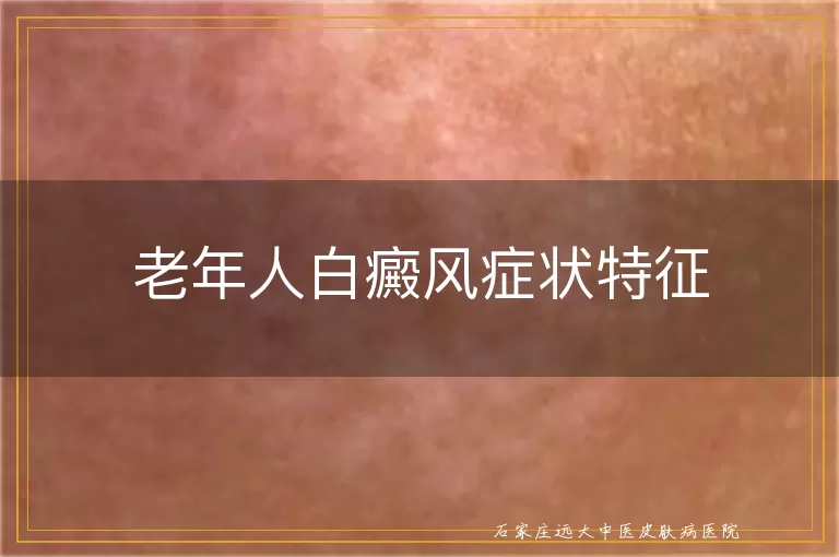 老年人白癜风症状特征