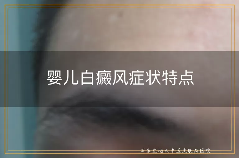 婴儿白癜风症状特点
