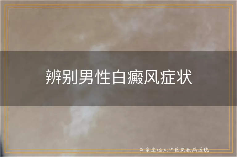 辨别男性白癜风症状