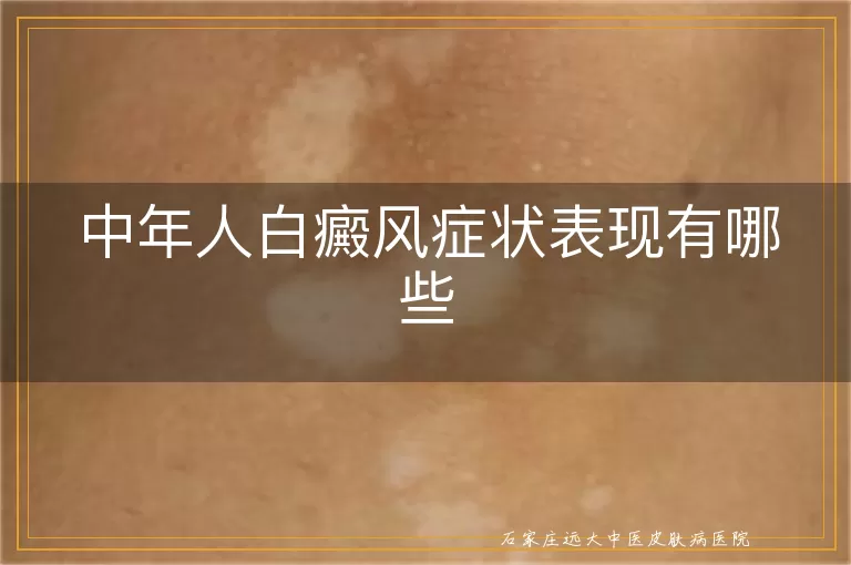 中年人白癜风症状表现有哪些
