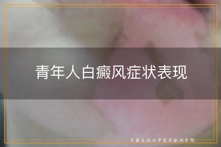 青年人白癜风症状表现
