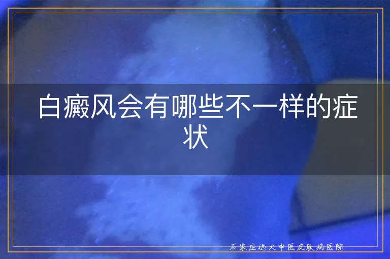白癜风会有哪些不一样的症状