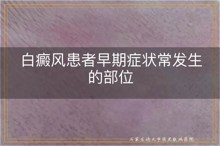 白癜风患者早期症状常发生的部位