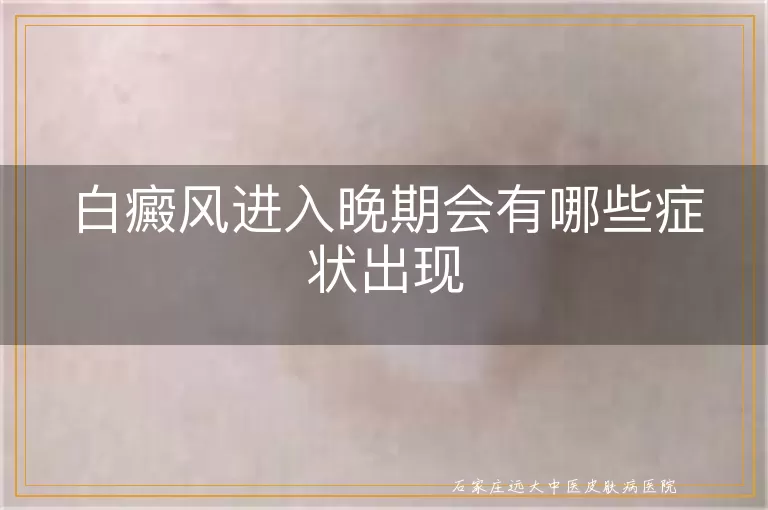 白癜风进入晚期会有哪些症状出现