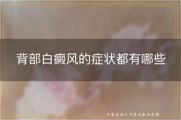 背部白癜风的症状都有哪些
