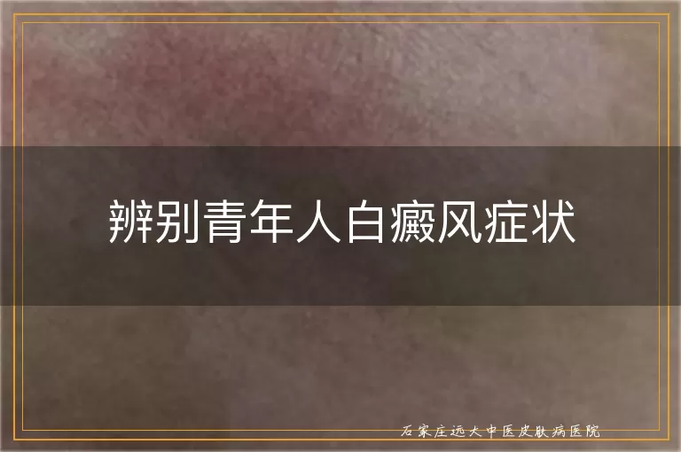 辨别青年人白癜风症状