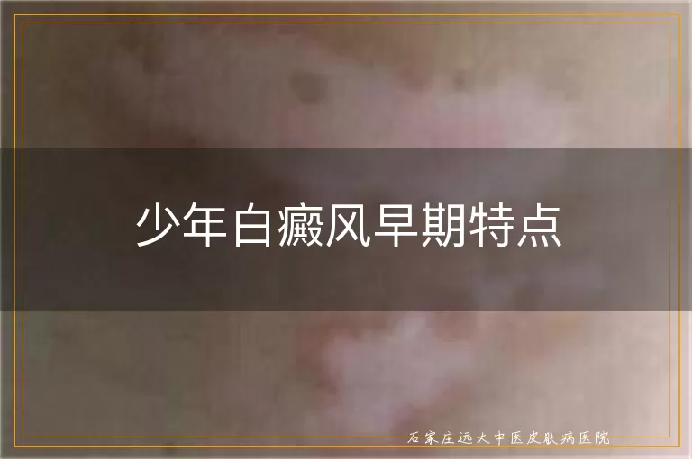 少年白癜风早期特点