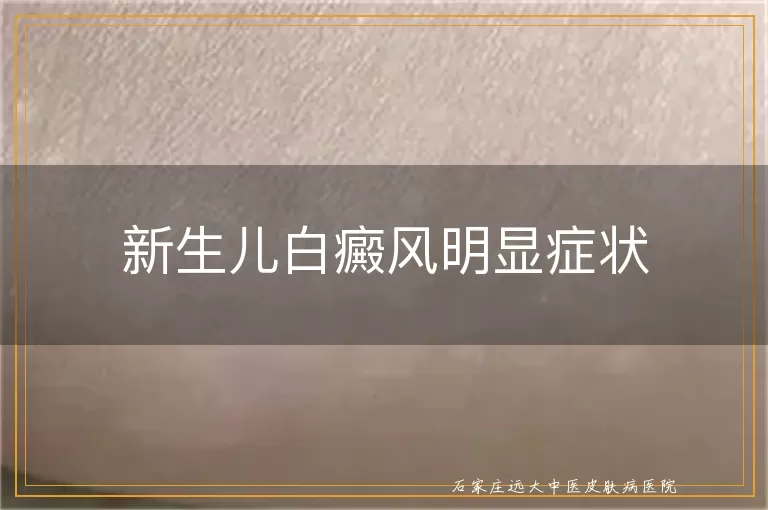 新生儿白癜风明显症状