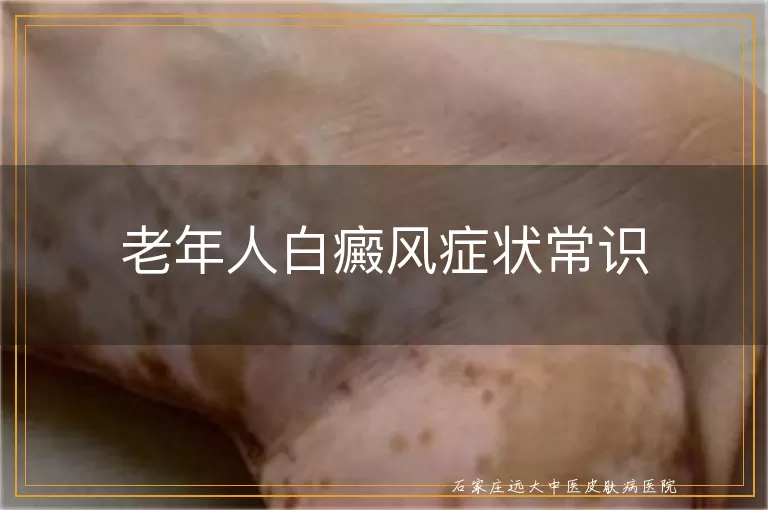 老年人白癜风症状常识