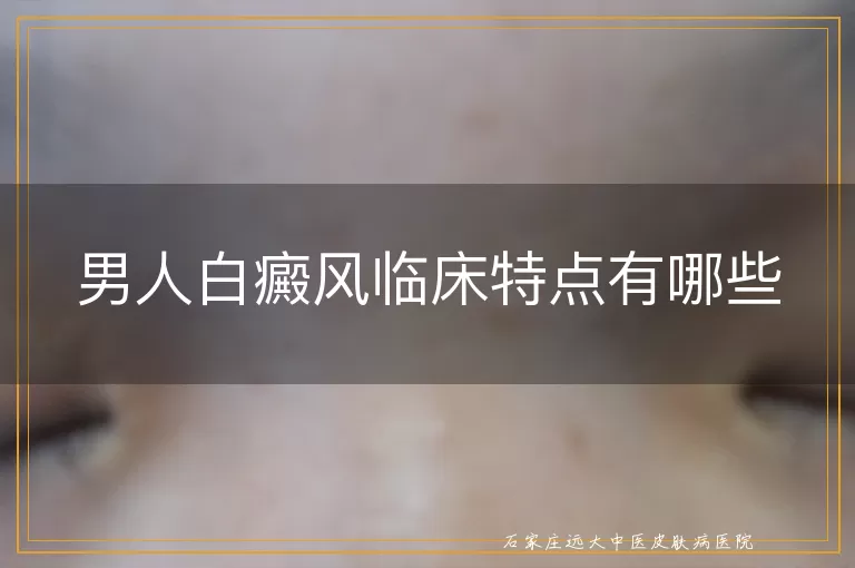 男人白癜风临床特点有哪些