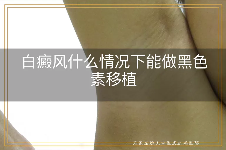 白癜风什么情况下能做黑色素移植