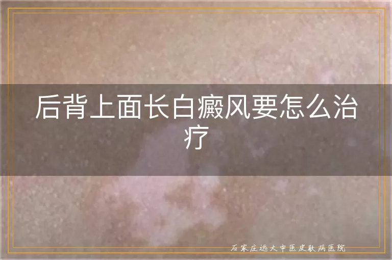 后背上面长白癜风要怎么治疗