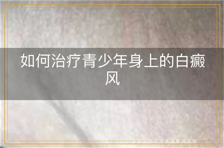 如何治疗青少年身上的白癜风