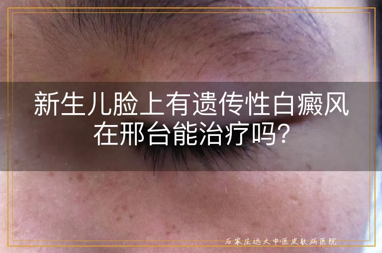 新生儿脸上有遗传性白癜风在邢台能治疗吗？