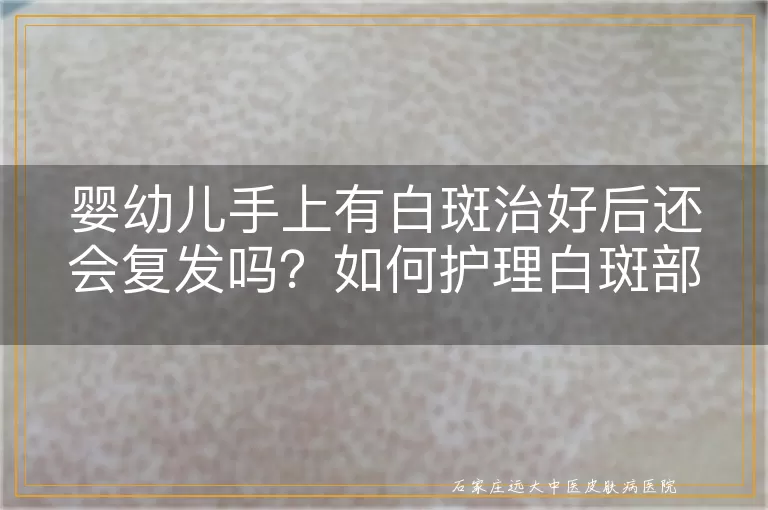 婴幼儿手上有白斑治好后还会复发吗？如何护理白斑部位