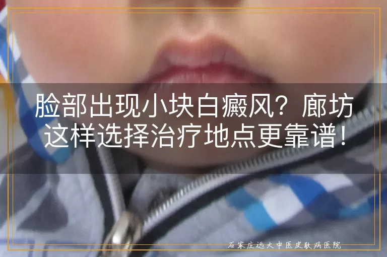 脸部出现小块白癜风？廊坊这样选择治疗地点更靠谱！