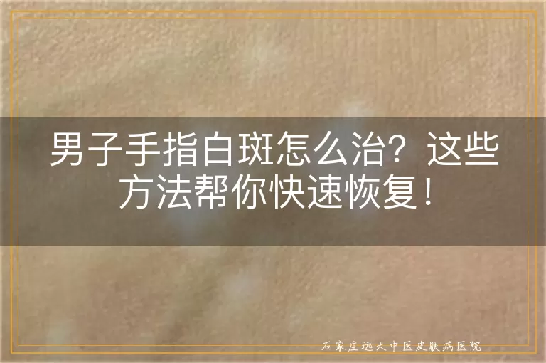 男子手指白斑怎么治？这些方法帮你快速恢复！