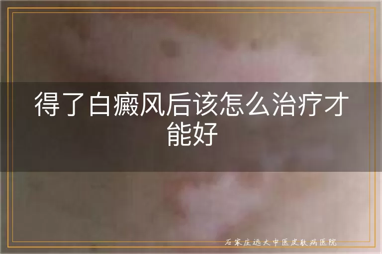 得了白癜风后该怎么治疗才能好