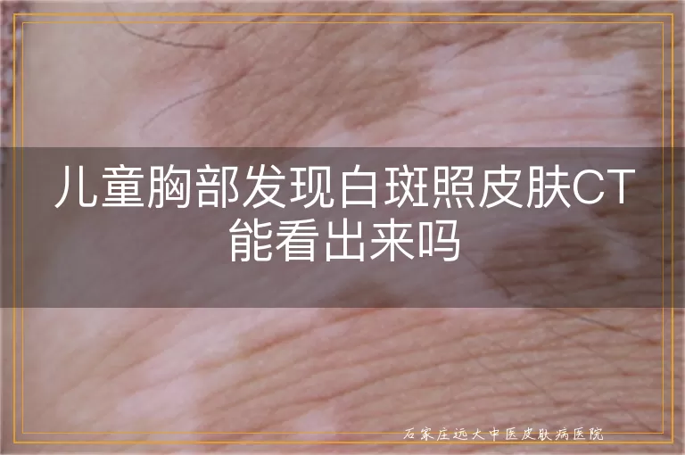 儿童胸部发现白斑照皮肤CT能看出来吗