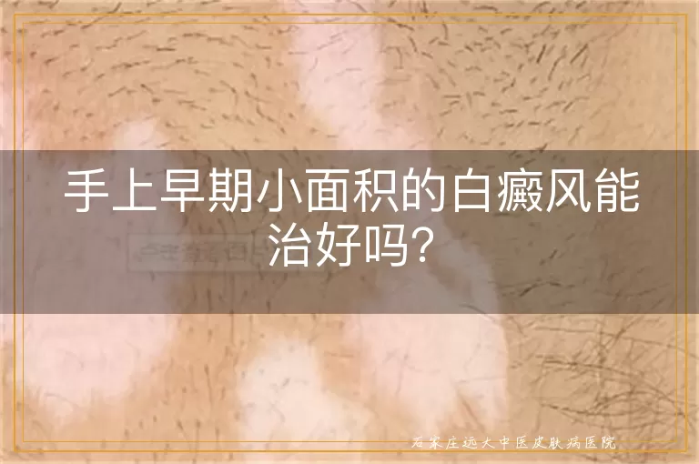 手上早期小面积的白癜风能治好吗？