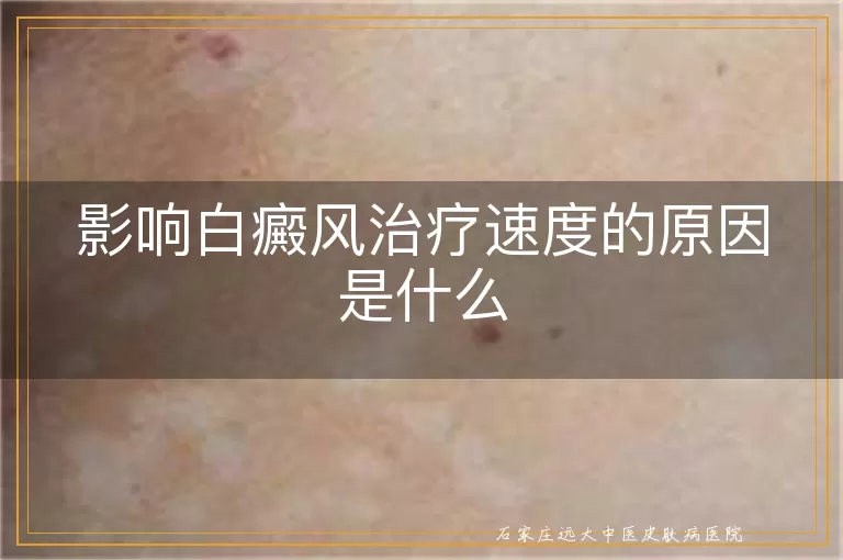 影响白癜风治疗速度的原因是什么