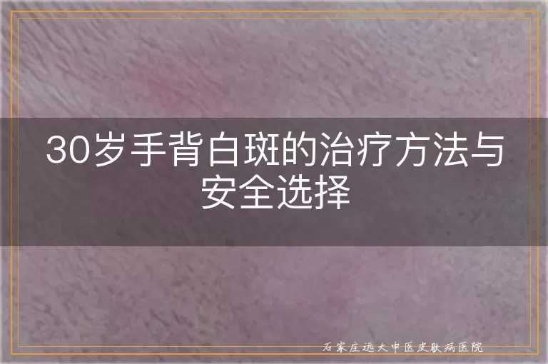 30岁手背白斑的治疗方法与安全选择