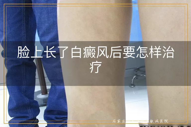 脸上长了白癜风后要怎样治疗