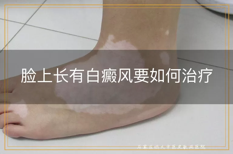 脸上长有白癜风要如何治疗