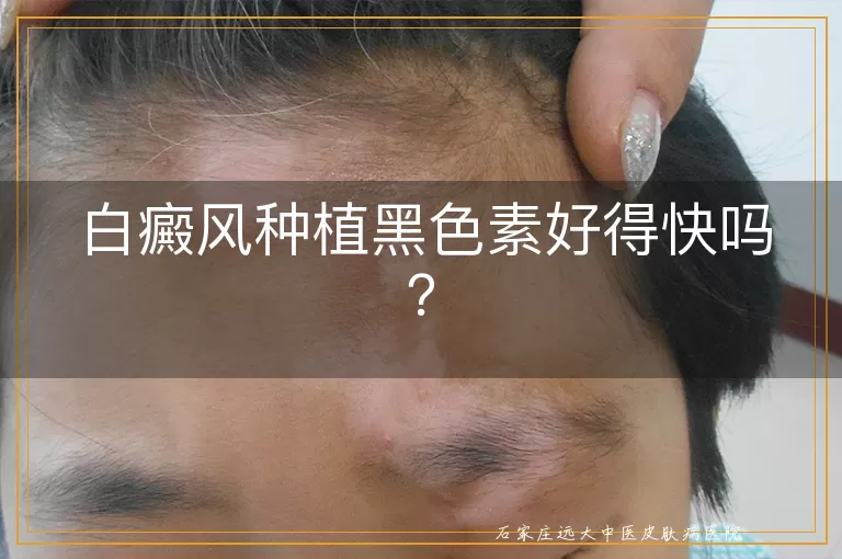 白癜风种植黑色素好得快吗？