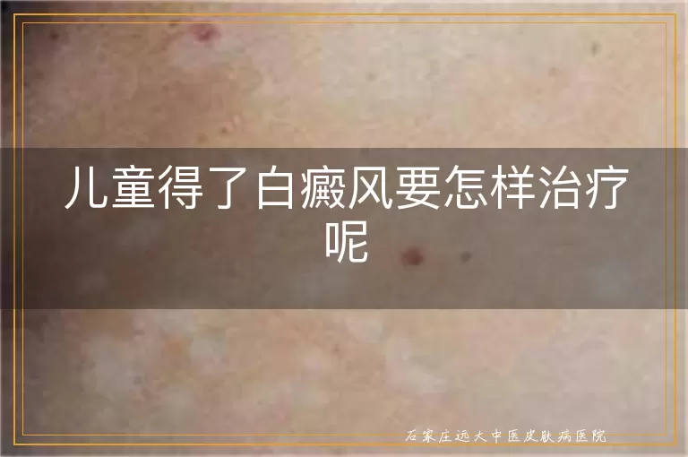 儿童得了白癜风要怎样治疗呢