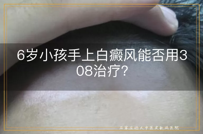 6岁小孩手上白癜风能否用308治疗？