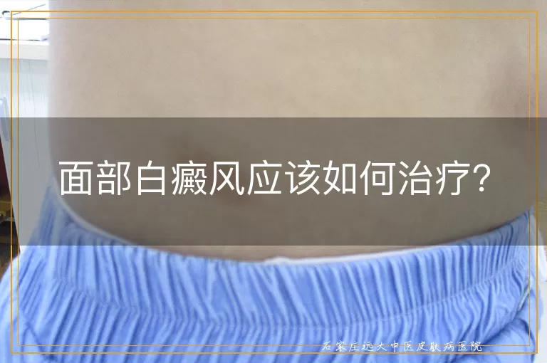 面部白癜风应该如何治疗？