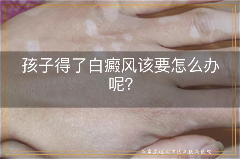 孩子得了白癜风该要怎么办呢？