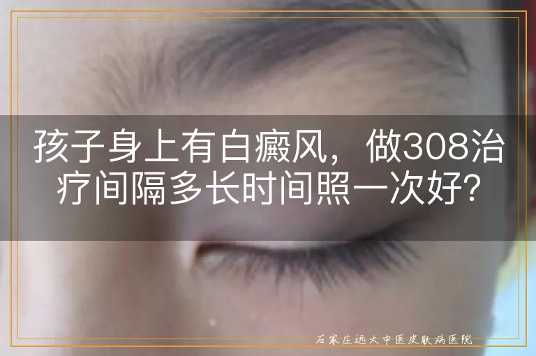 孩子身上有白癜风，做308治疗间隔多长时间照一次好？