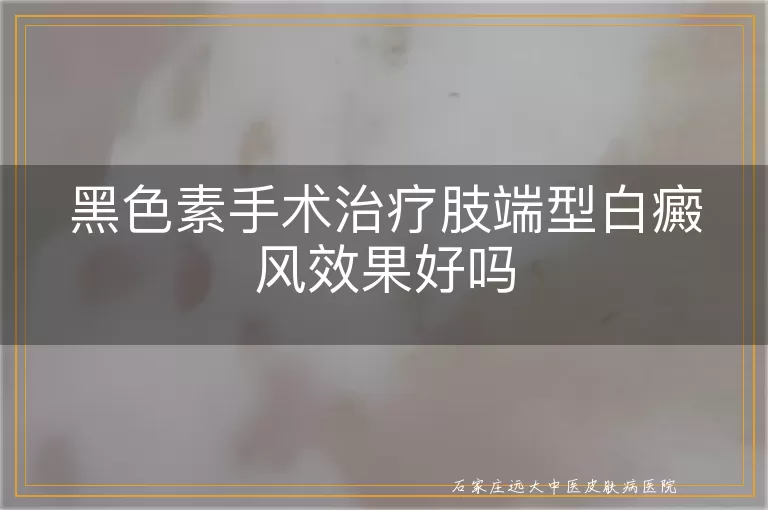 黑色素手术治疗肢端型白癜风效果好吗